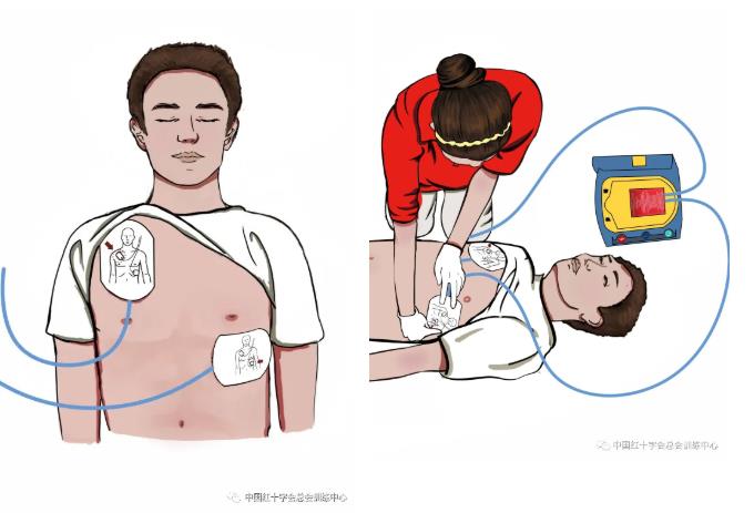 My AED 电极片粘贴位置 胸部示意 使用步骤图