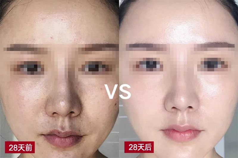 VivaLight焕肤灯使用前后对比效果