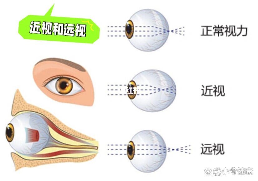 驰云远视 是什么意思 视力问题 科普