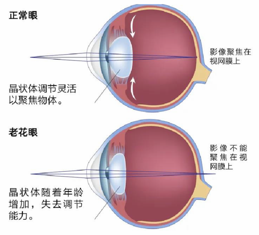 驰云远视 误区 近视混淆 老花提前 注意事项